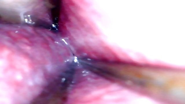 A Glimpse into the Mysteries of an Extensive Urethral Canal – The First Chapter