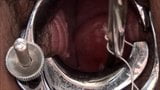 Laminary (kelp) stick insertion in the cervix snapshot 7