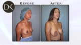 Dual Plane Breast  b4 and after snapshot 3