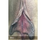 Labia -reduceringsglas snapshot 8