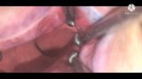 Huge Anal dilator with massive gape and nice Prolapse ending snapshot 4