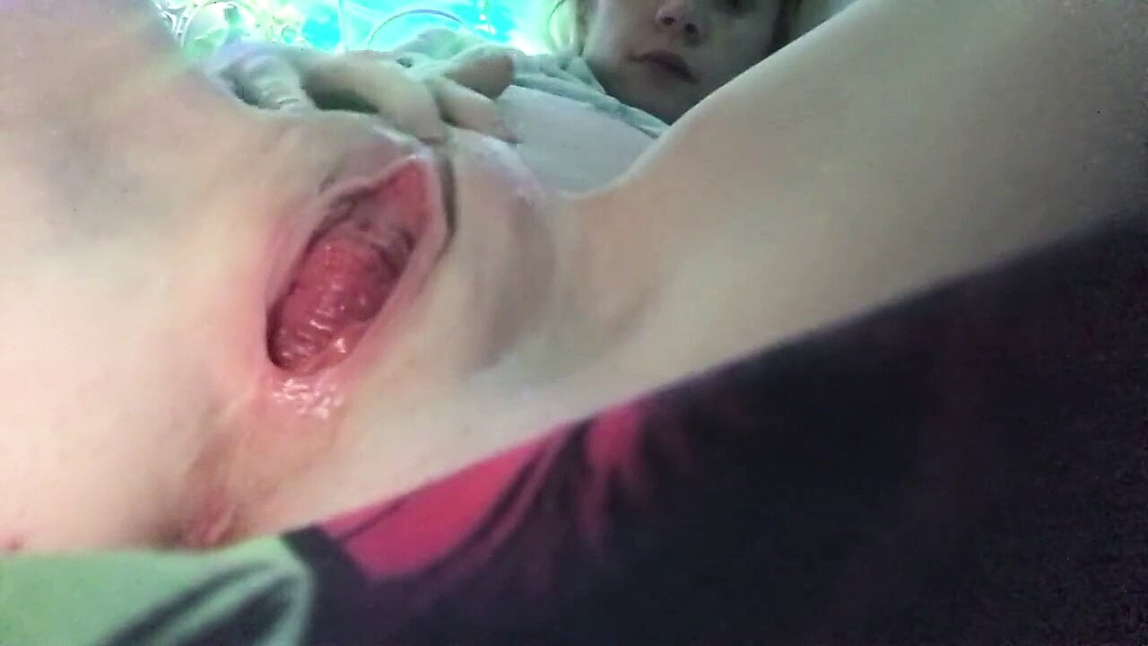 Pregnant cervix prolapse