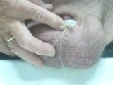 Penectomy Penis snapshot 6