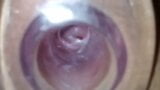 Clear tunnel plug with cervix view snapshot 1