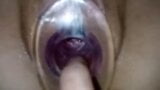 Clear tunnel plug with cervix view snapshot 2