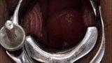 Laminary (kelp) stick insertion in the cervix snapshot 6