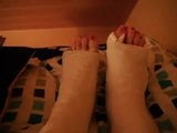 wiggling toes sticking out of two fresh plaster casts snapshot 1