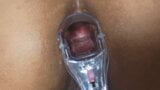 Speculum in my anus snapshot 12