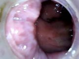 Anal endoscope part 2 snapshot 1