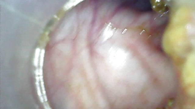 Exciting journey into the depths of your digestive system: Welcome to your first colonoscopy!
