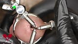 Close up of the application of a 3-way urethral stretcher. The dilator is used to pre-stretch. snapshot 11