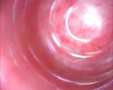 Endoscope Photo Galery - Male Rectal Insertion snapshot 19